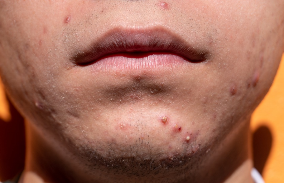 acne